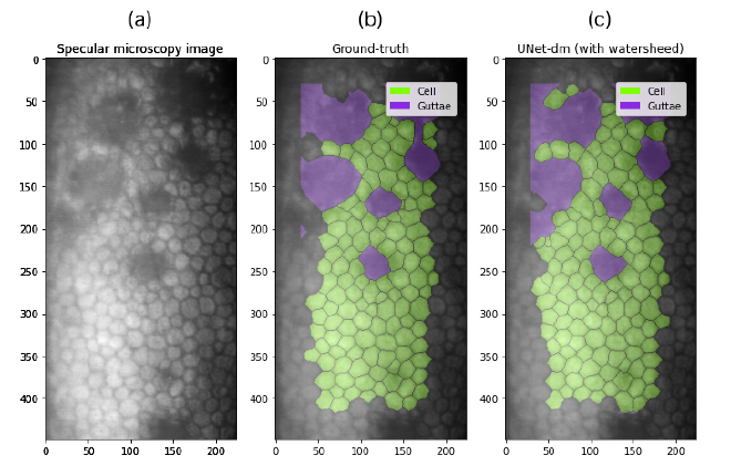 (a) CE image acquired by specular microscopy, (b) Ground truth segmentation, (c) Watersheed segmentation (UNet-mask).